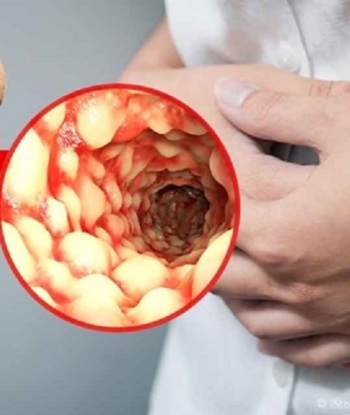 Sëmundja Crohn. Identifikohen gjenet e përfshira në rrezikun e zhvillimit të saj